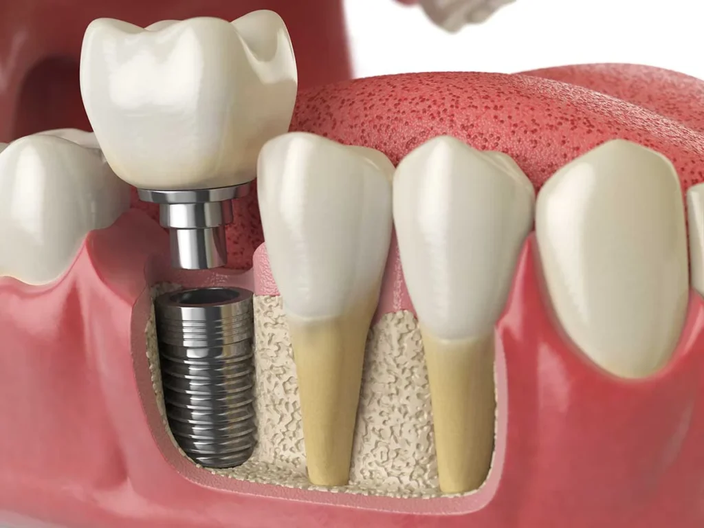 Is Titanium Toxic? The Ultimate Safety Guide (Implants, Jewelry & Cookware) 2 A safe titanium dental implant securely fused with jawbone through the process of osseointegration.