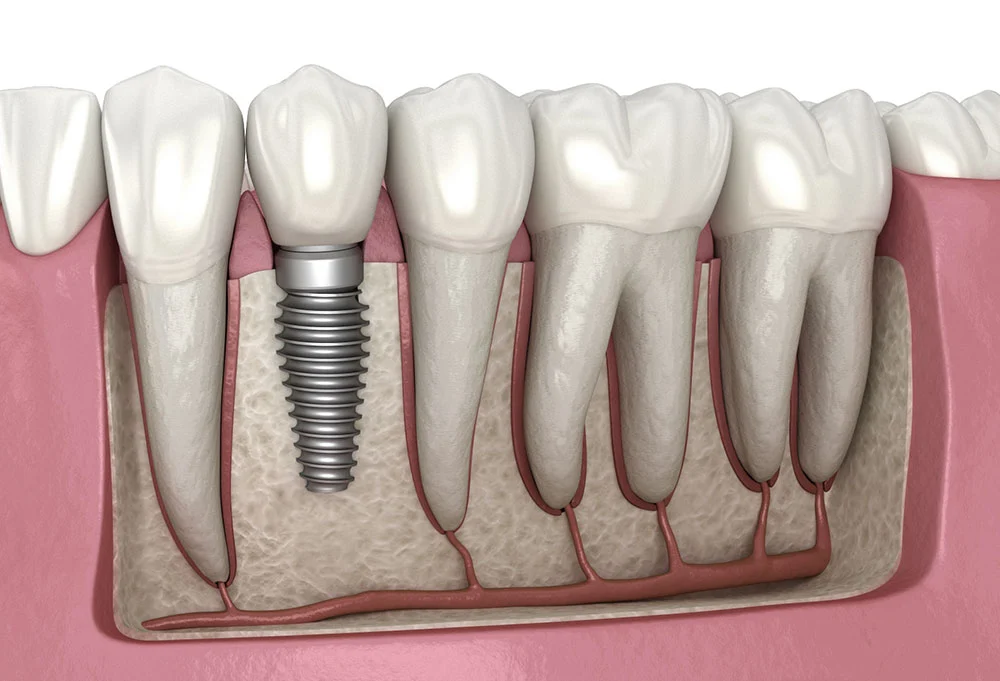 Why Titanium Is the Safest Metal for Medical Implants — And What "Biocompatible" Actually Means 2 Dental implant illustration showing titanium screw, abutment, and crown components — Wikimedia Commons