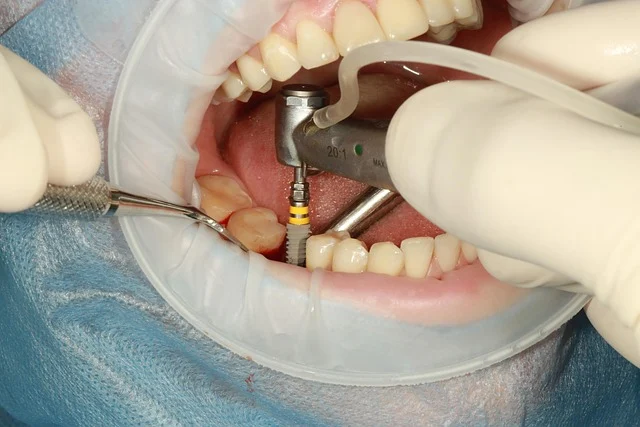 Why Titanium Is the Safest Metal for Medical Implants — And What "Biocompatible" Actually Means 8 Dental implant procedure model showing titanium screw placement in jawbone