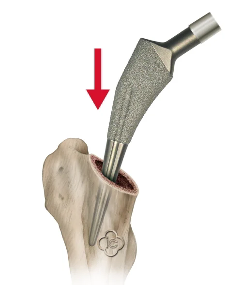Why Titanium Is the Safest Metal for Medical Implants — And What "Biocompatible" Actually Means 5 Total hip replacement prosthesis — titanium femoral stem and cup — clinical photograph