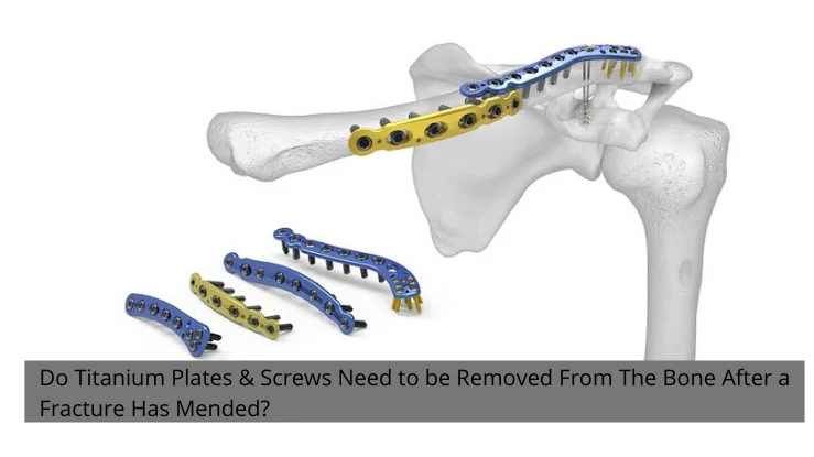 Why Titanium Is the Safest Metal for Medical Implants — And What "Biocompatible" Actually Means 7 X-ray showing titanium plates and screws in orthopedic fixation — bone-to-implant interface