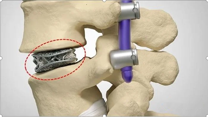 Titânio CP vs. Liga de Titânio (Ti-6Al-4V): Um Guia Prático para a Seleção de Materiais 4 Componentes de implantes médicos em liga de titânio Ti-6Al-4V de grau 5, fabricados através de impressão 3D para aplicações ortopédicas