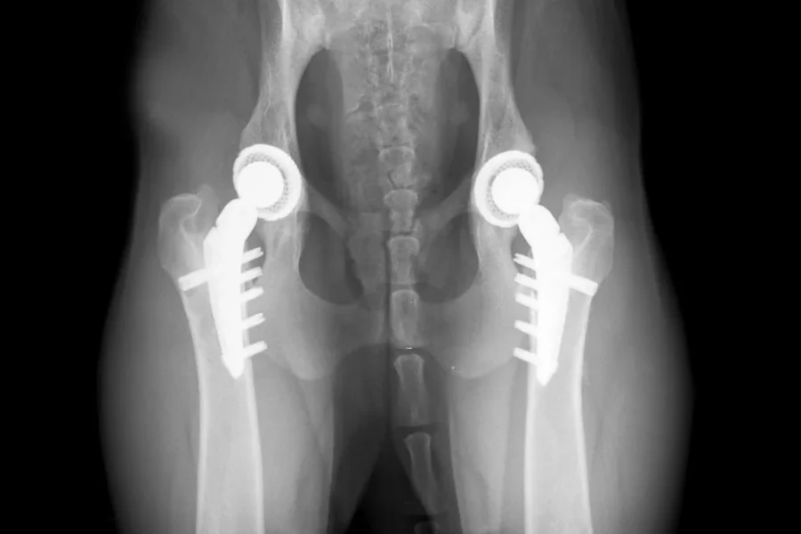 Medical X-ray showing a titanium joint replacement implant.